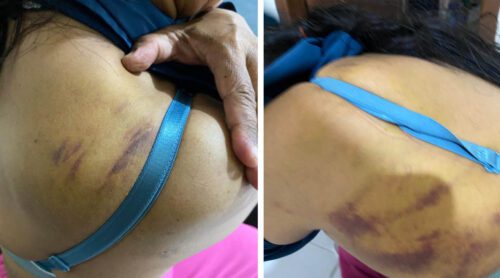 Diduga Aniaya ART, Oknum Dokter PNS di Bandar Lampung Dilaporkan ke Polisi